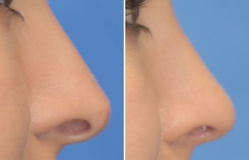 Female patient before and after rhinoplasty
