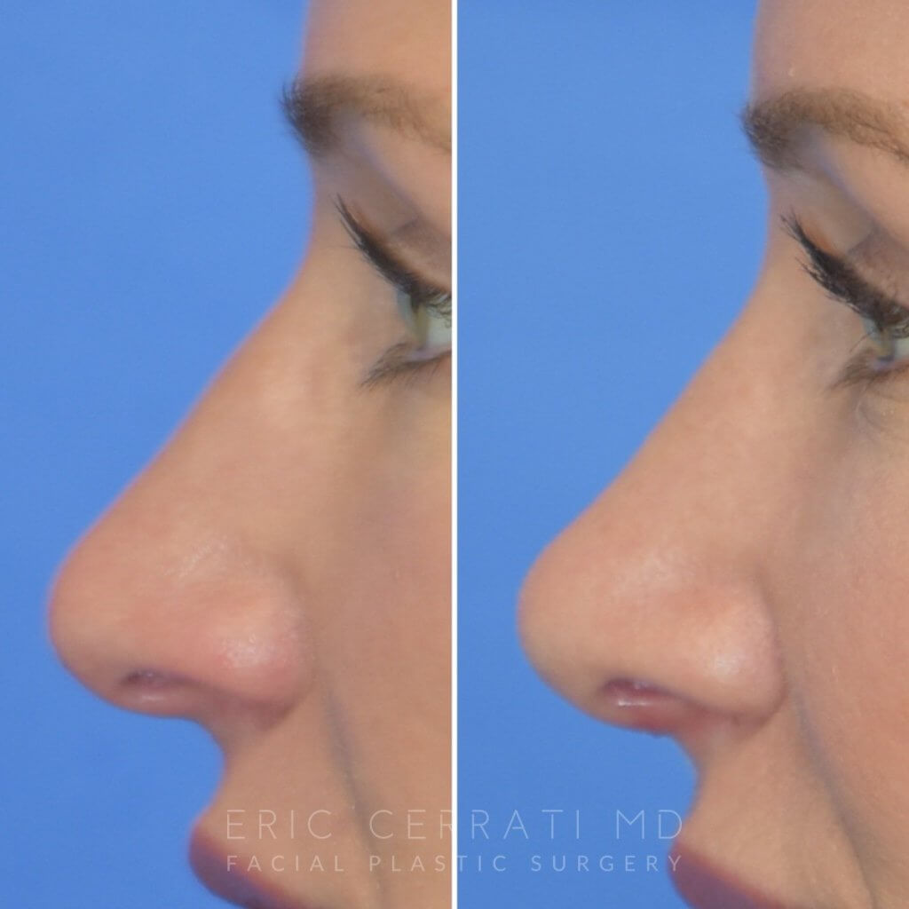 Female patient before and after rhinoplasty