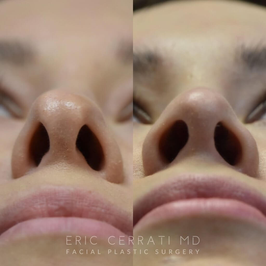 Female patient before and after rhinoplasty