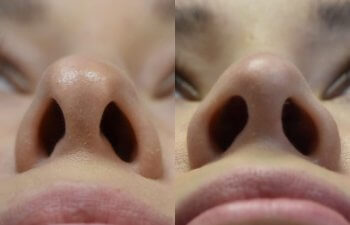 Female patient before and after rhinoplasty