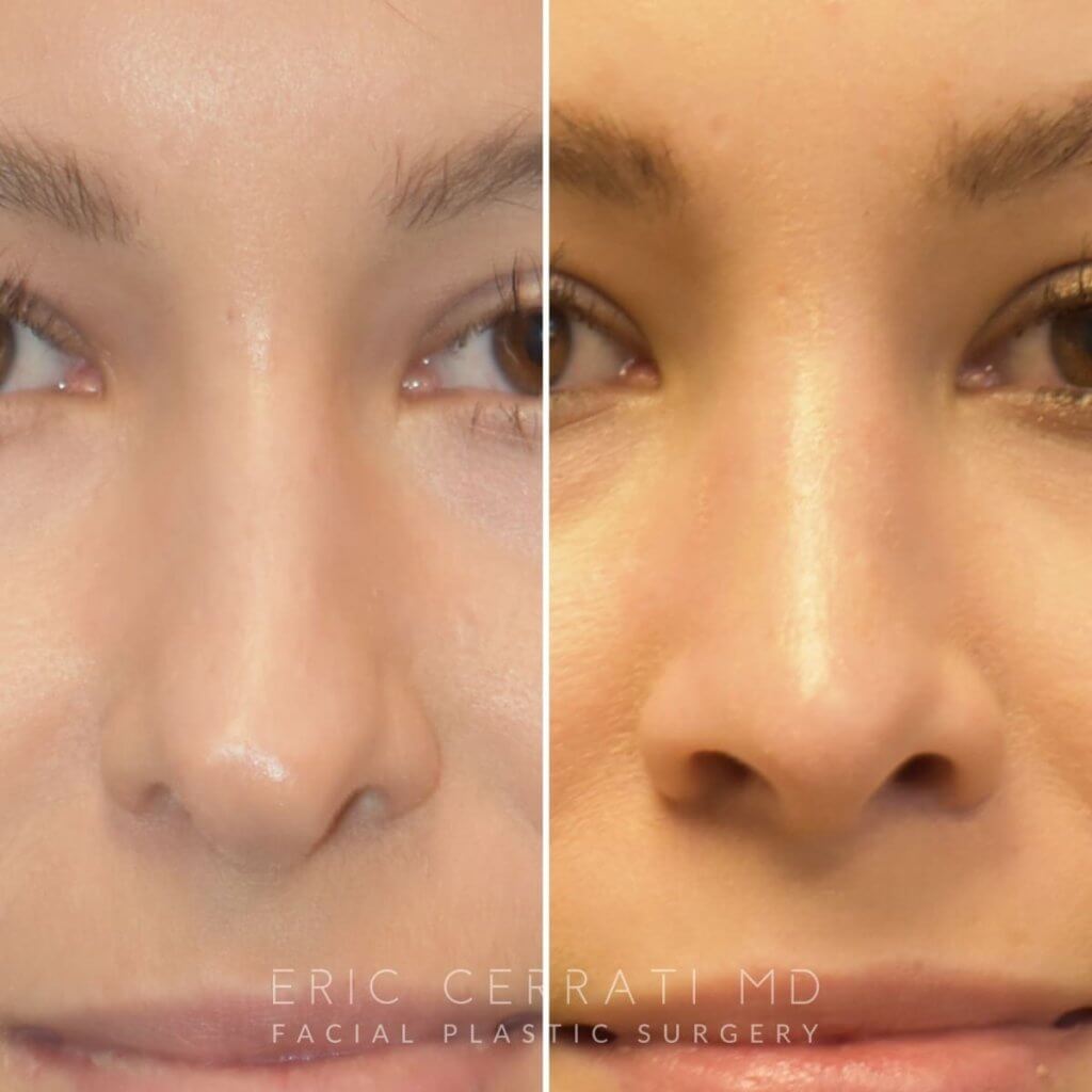 Female patient before and after rhinoplasty