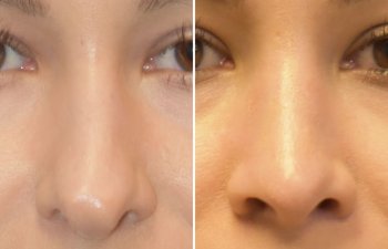 Female patient before and after rhinoplasty