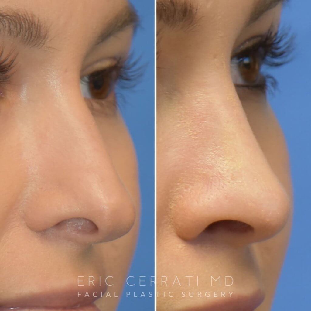 Female patient before and after rhinoplasty