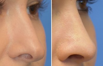 Female patient before and after rhinoplasty
