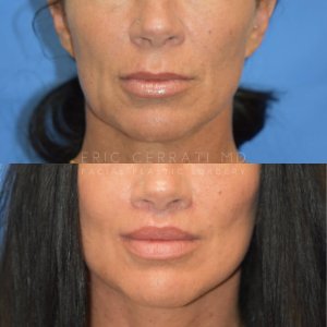 lips before and after photo