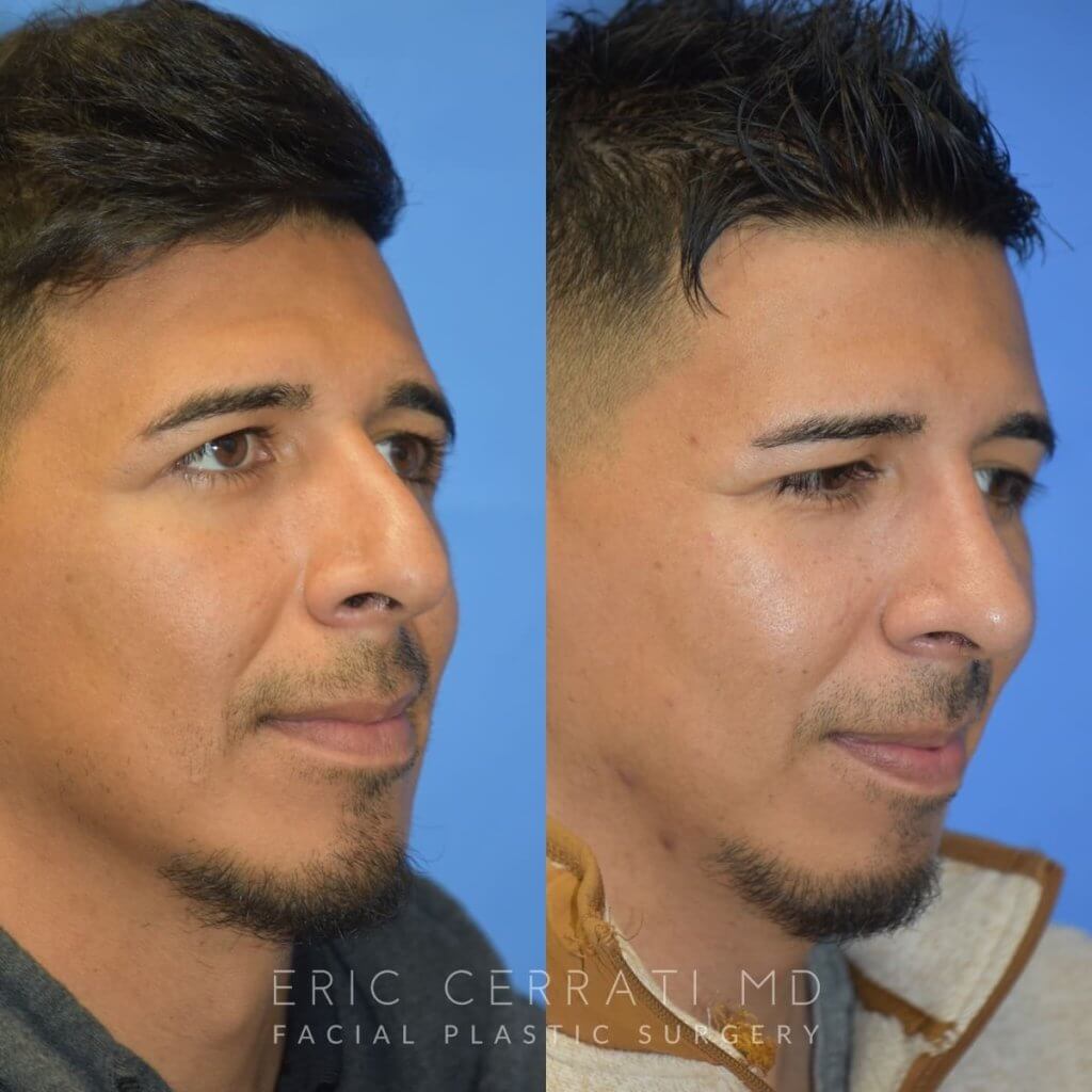 Male patient before and after rhinoplasty