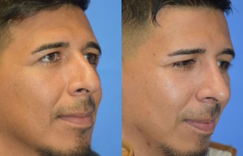 Male patient before and after rhinoplasty