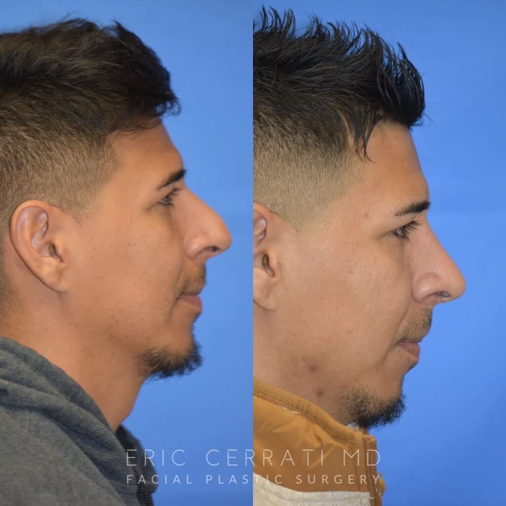 Male patient before and after rhinoplasty
