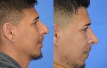 Male patient before and after rhinoplasty