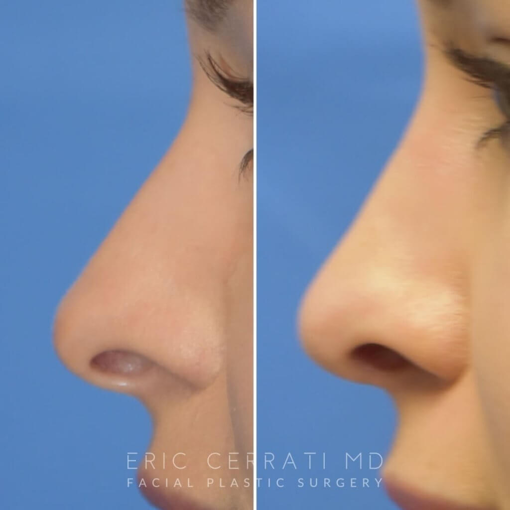 Female patient before and after rhinoplasty