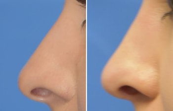 Female patient before and after rhinoplasty