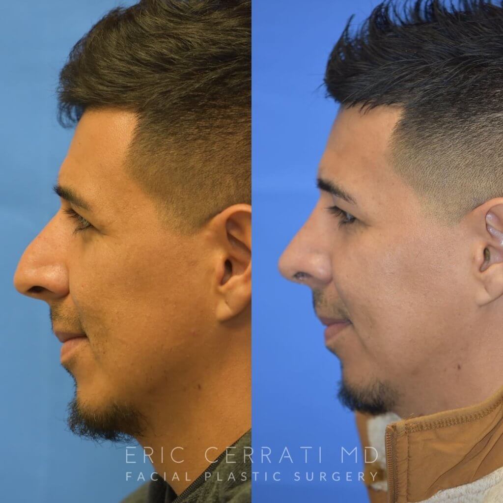 Male patient before and after rhinoplasty