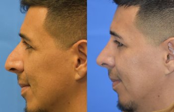 Male patient before and after rhinoplasty