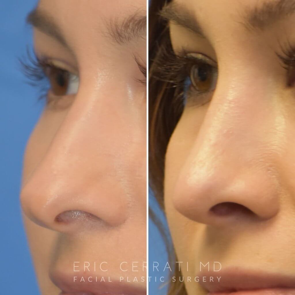 Female patient before and after rhinoplasty