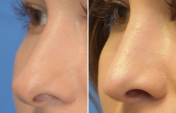 Female patient before and after rhinoplasty