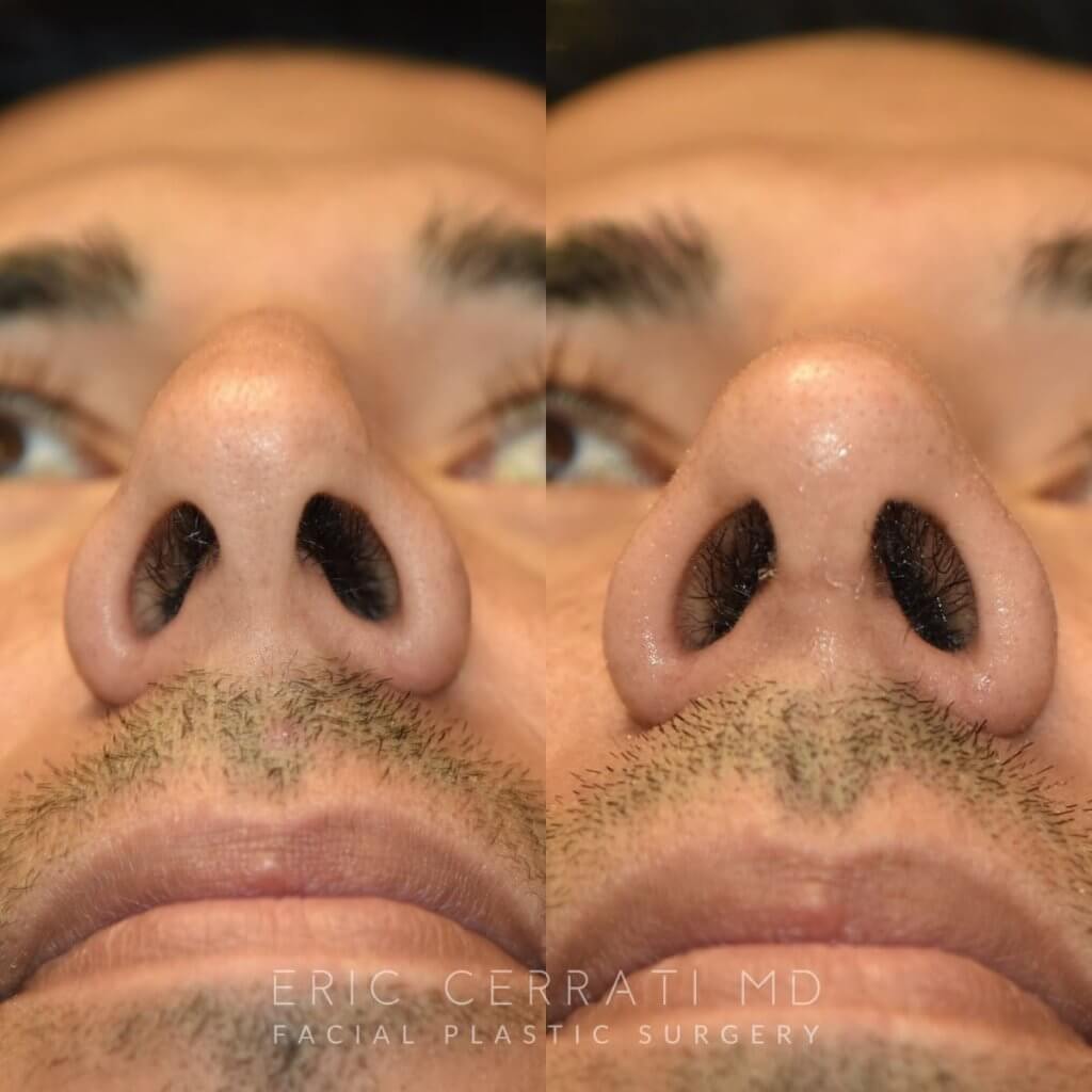 Male patient before and after rhinoplasty