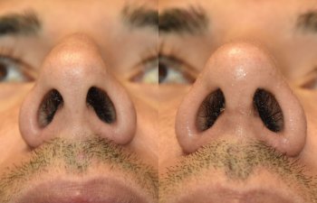 Male patient before and after rhinoplasty
