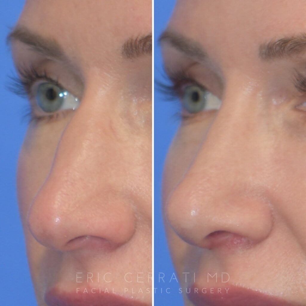 Female patient before and after rhinoplasty
