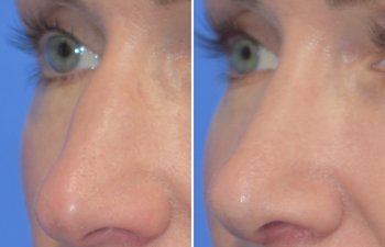 Female patient before and after rhinoplasty