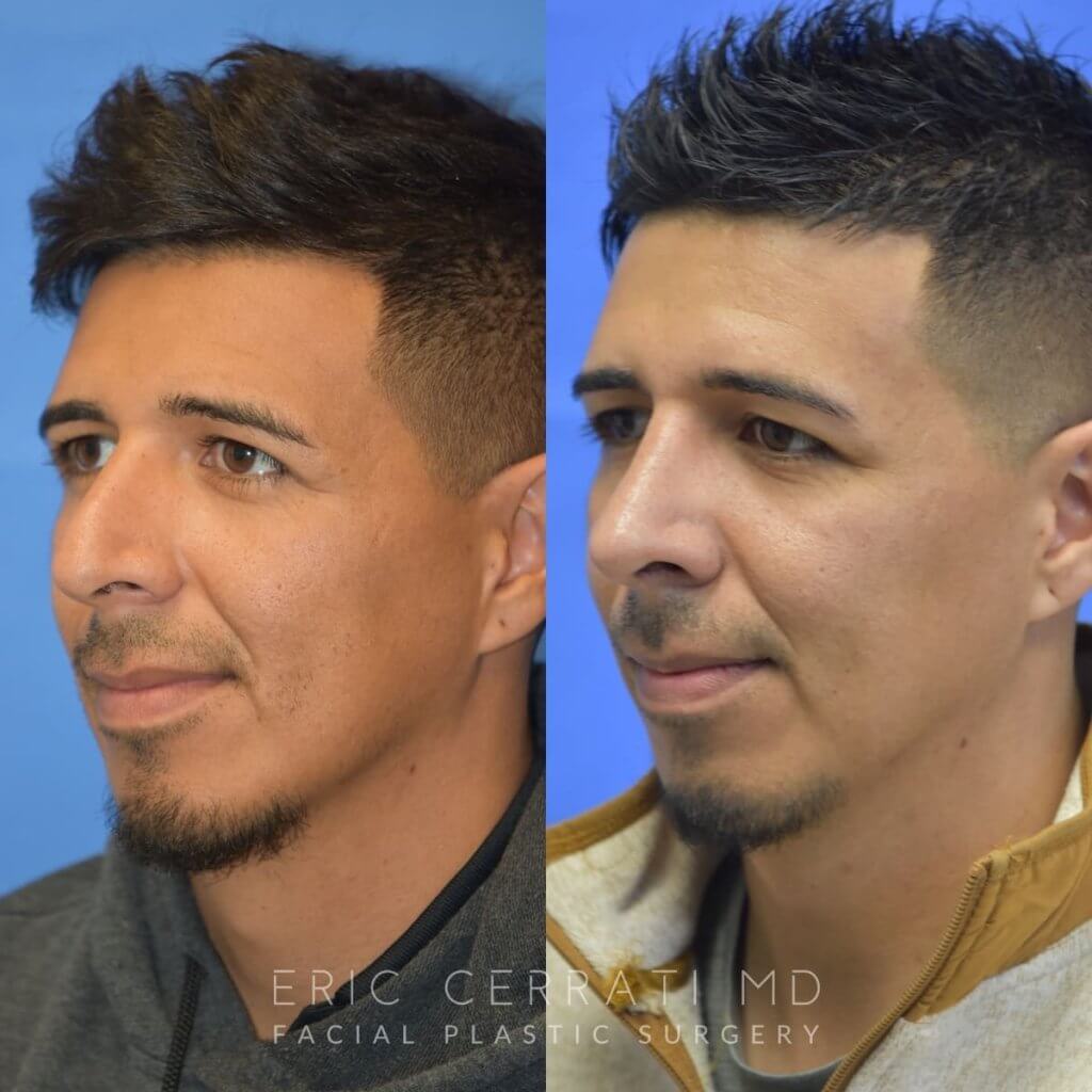 Male patient before and after rhinoplasty