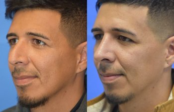 Male patient before and after rhinoplasty