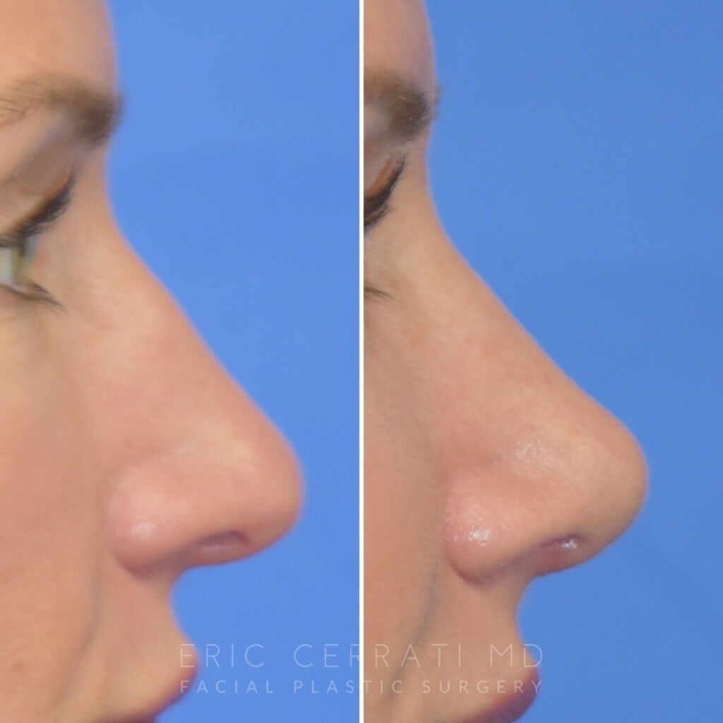 Female patient before and after rhinoplasty