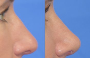 Female patient before and after rhinoplasty