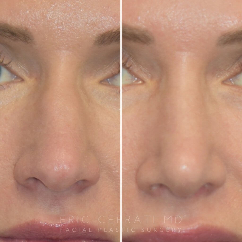 Female patient before and after rhinoplasty