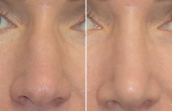 Female patient before and after rhinoplasty