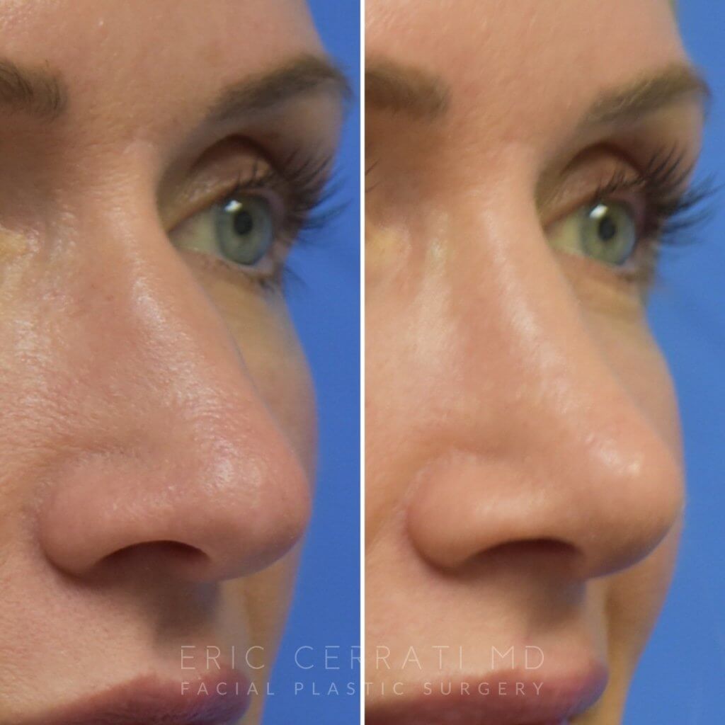 Female patient before and after rhinoplasty