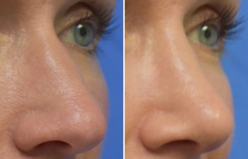Female patient before and after rhinoplasty