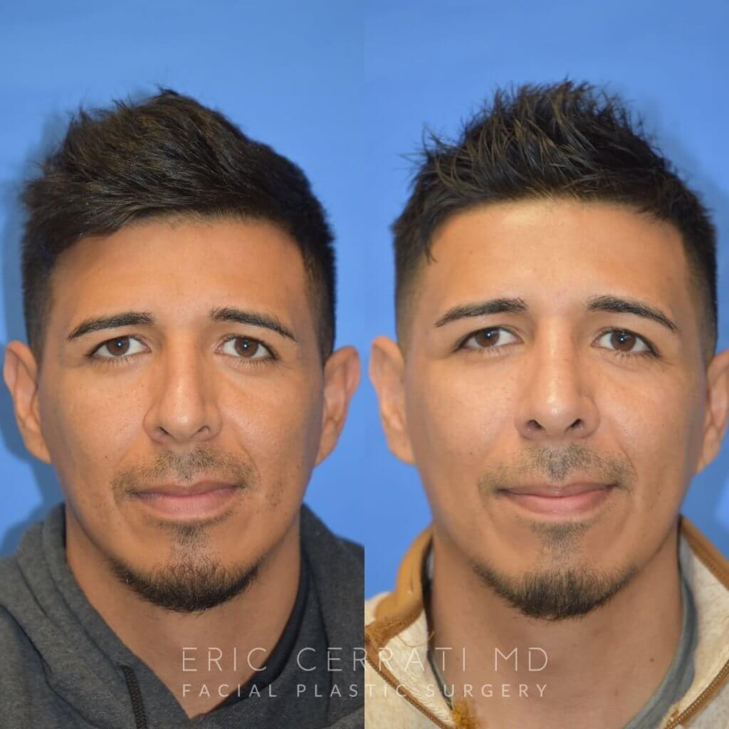 Male patient before and after rhinoplasty