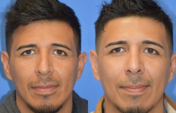 Male patient before and after rhinoplasty