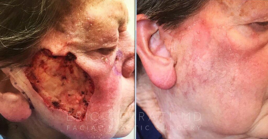 patient before and after upper right side of face reconstructive surgery