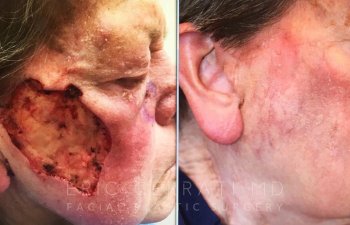 patient before and after upper right side of face reconstructive surgery
