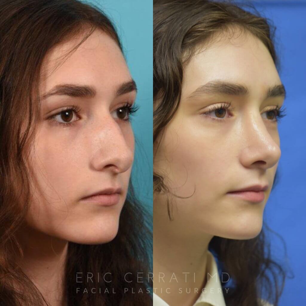 Female patient before and after rhinoplasty - right side