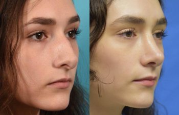 Female patient before and after rhinoplasty - right side