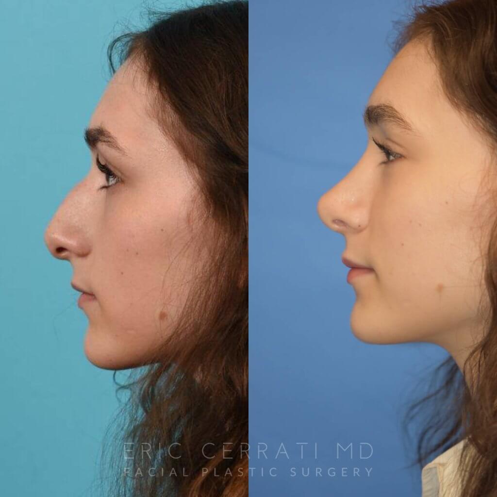 Female patient before and after rhinoplasty - left side