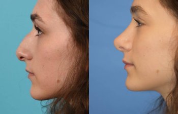 Female patient before and after rhinoplasty - left side