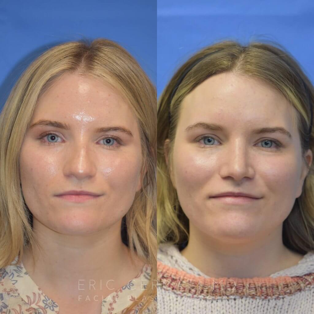 Female patient before and after rhinoplasty
