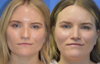 Female patient before and after rhinoplasty