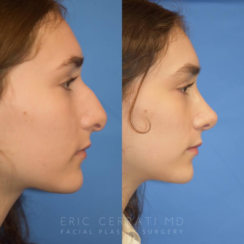 Female patient before and after rhinoplasty - right side