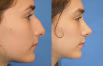 Female patient before and after rhinoplasty - right side