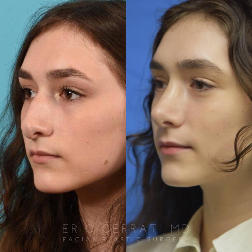 Female patient before and after rhinoplasty - left side