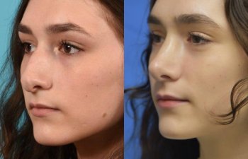Female patient before and after rhinoplasty - left side