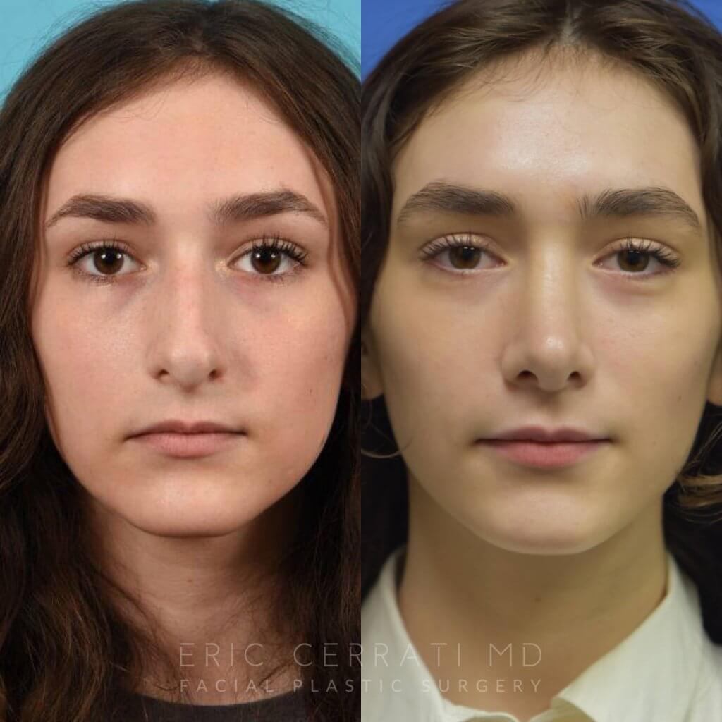 Female patient before and after rhinoplasty - front