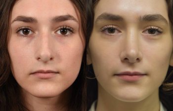 Female patient before and after rhinoplasty - front