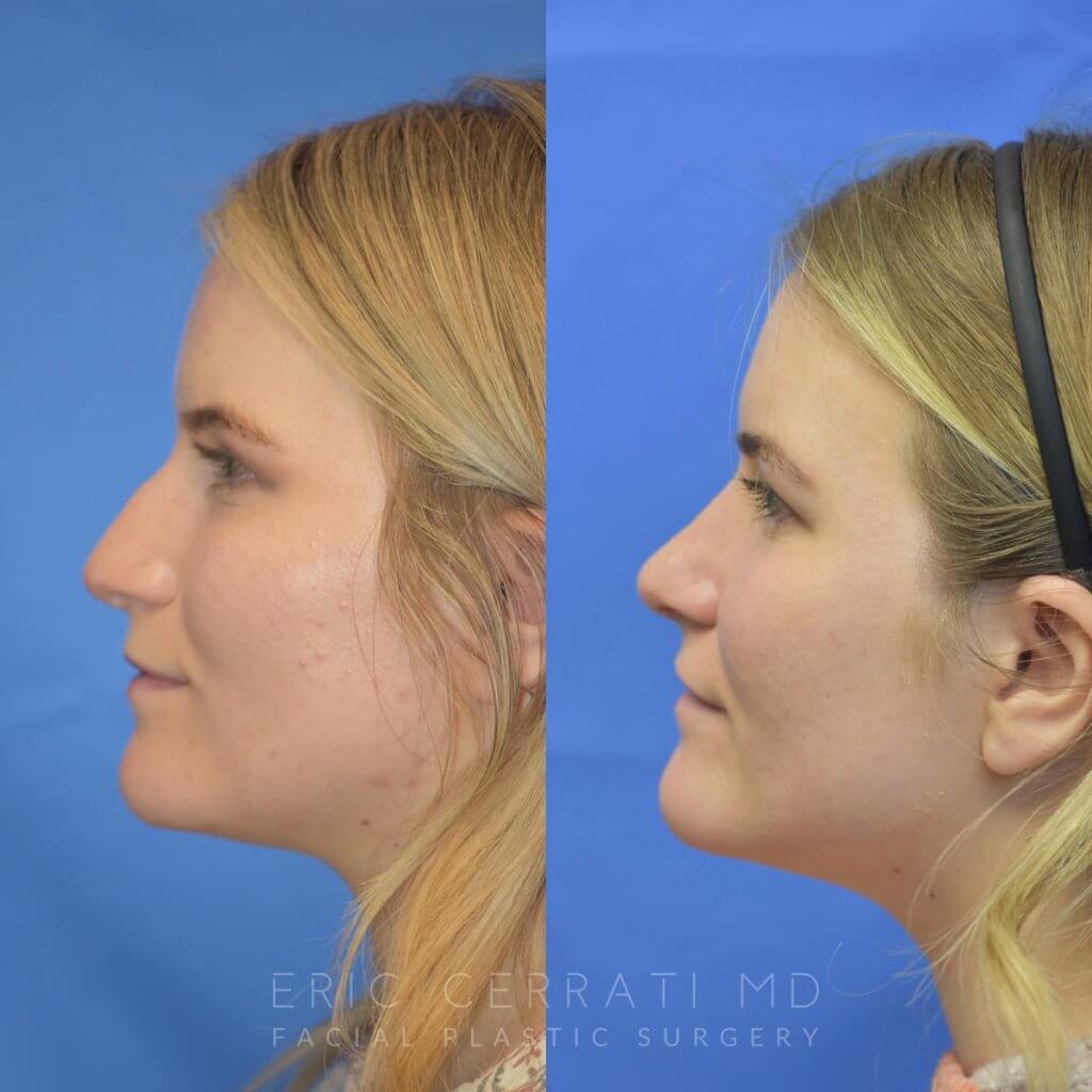 Female patient before and after rhinoplasty