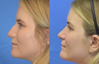 Female patient before and after rhinoplasty
