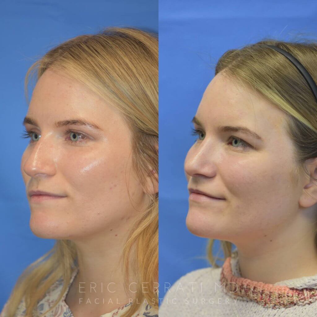 Female patient before and after rhinoplasty